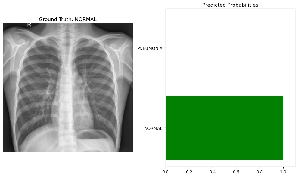 A normal chest X-ray next to a bar chart of predicted probabilities. The model puts almost all of the probability on normal, which is the correct class.