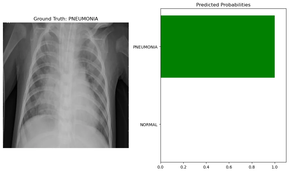 A chest X-ray labeled pneumonia next to a bar chart of predicted probabilities. The model puts almost all of the probability on pneumonia, which is the correct class.