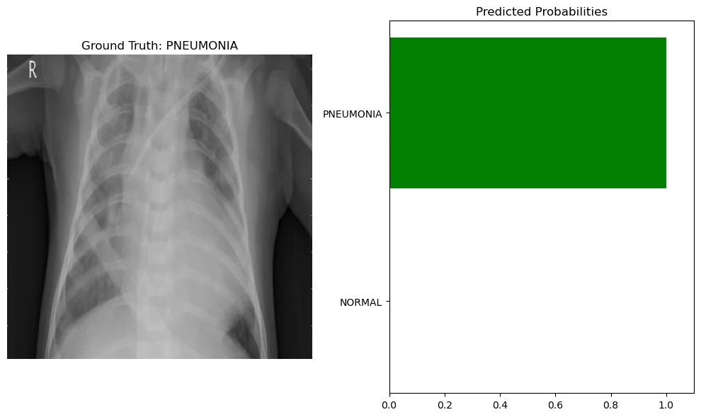 A chest X-ray labeled pneumonia next to a bar chart of predicted probabilities. The model puts almost all of the probability on pneumonia, which is the correct class.
